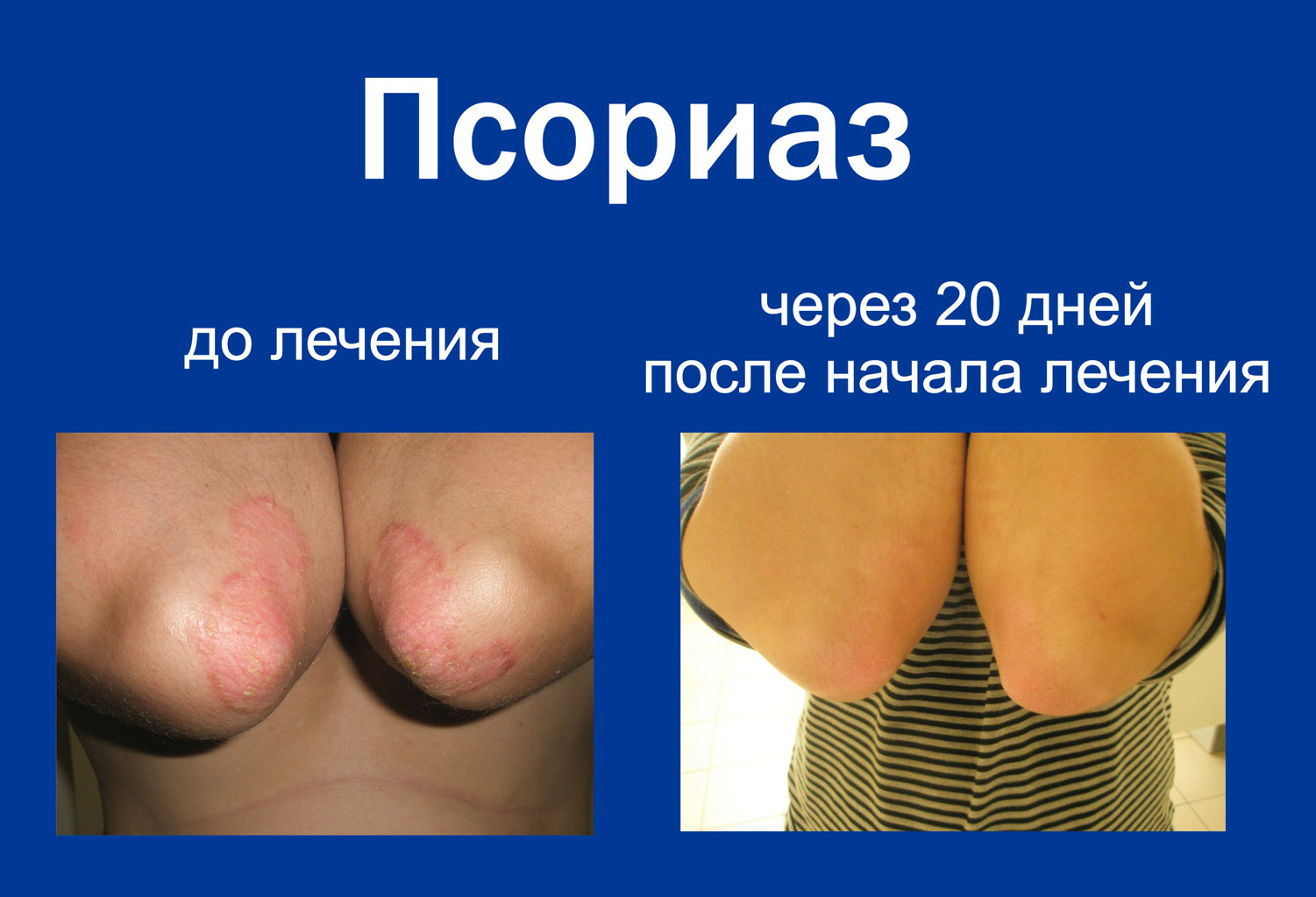 Лечение без гормонов