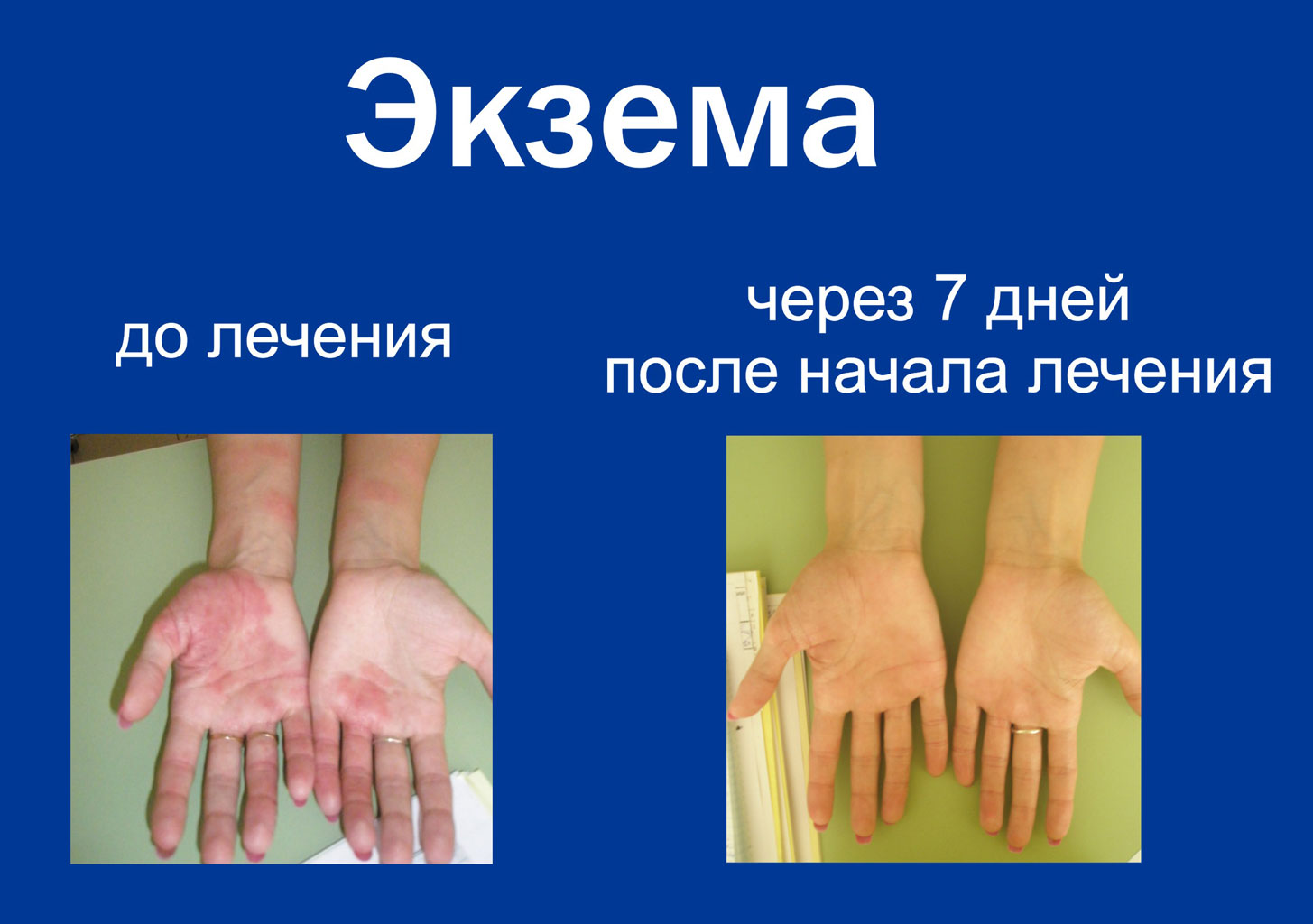 Псориаз что это такое
